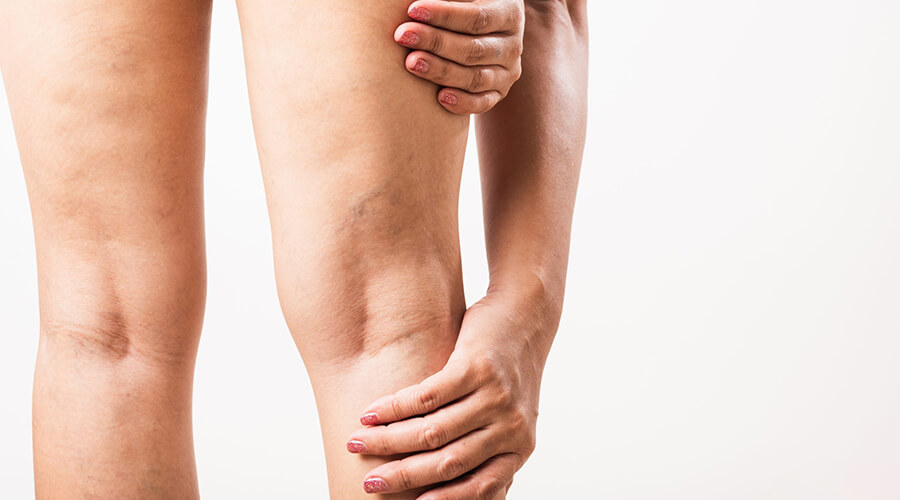 4 serious complications caused by neglected varicose veins