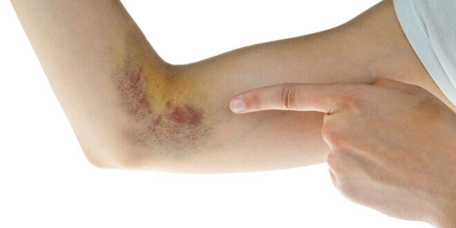 The best remedies for bruising!